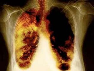 leziuni pulmonare atunci când utilizați nicotină